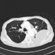 Loculated pleural fluid, aneurysm of left ventricle, apical and thrombosed: CT - Computed tomography